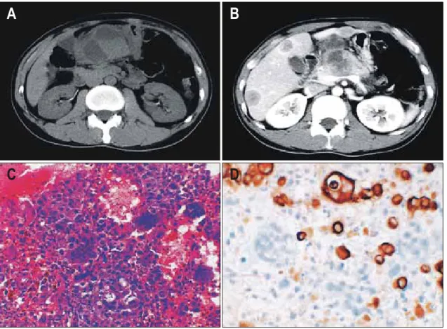 Fig.  2.  Radiologic  and  pathologic  findings  of  case  2.  (A)  In  precontrast  CT  scan,  pancreatic  body  mass  is  isodense  with  internal  low  density  portion  and  subhepatic  node  has  a  low  density  with  internal  high  density  portion