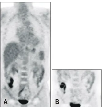 Fig.  3.  Excretory  FDG  activity  into  the  bowel  lumen.  (A)  A  coro- coro-nal  view  of  initial  whole  body  imaging  shows  tubular  increased  FDG  activity  in  right