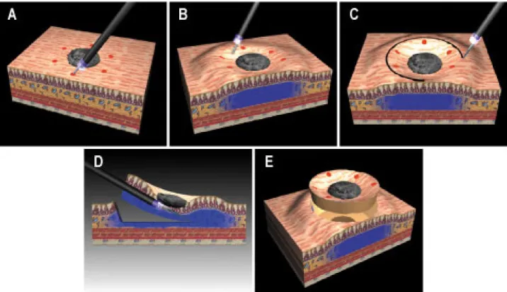 Fig.  1.  The  schematic  technical  method  of  EISD.  (A)  Marking.  (B)  Injection