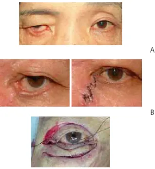 Figure 6.  Levator aponeurosis repair operation. Reproduced from Korean  Society of Ophthalmic Plastic and Reconstructive Surgery