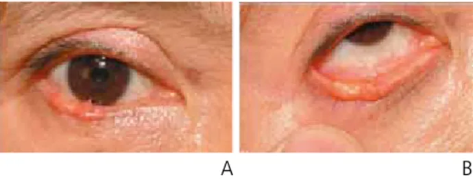 Figure 10.  Sebaceous cell carcinoma. Reproduced from Korean Society of  Ophthalmic Plastic and Reconstructive Surgery
