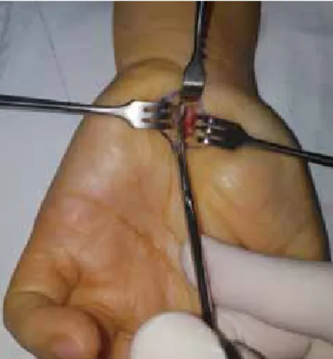 Figure 3.  Open carpal tunnel release.