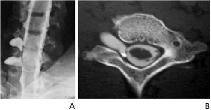 Figure 2.  (A) Coronal and (B) axial computed tomography myelography im- im-ages of pseudomeningocele.