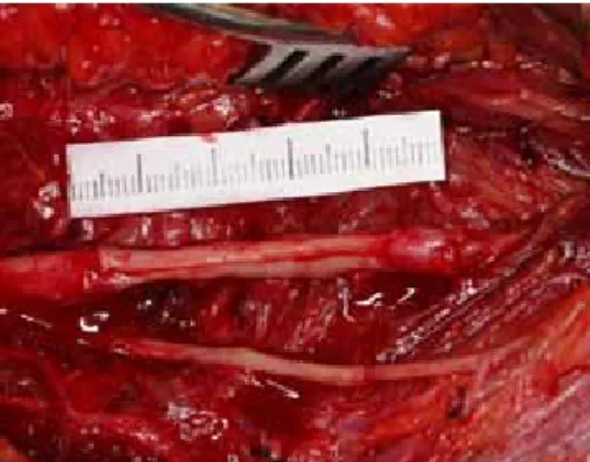 Figure 3.  Sural nerve grafting.