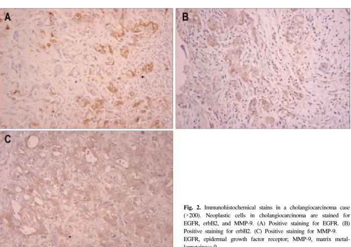 Fig.  2.  Immunohistochemical  stains  in  a  cholangiocarcinoma  case  (×200).  Neoplastic  cells  in  cholangiocarcinoma  are  stained  for  EGFR,  erbB2,  and  MMP-9