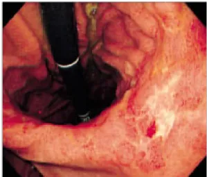 Fig.  5.  Histological  finding  of  case  2.  This  microscopic  section  shows  signet  ring  cell  carcinoma  (H&amp;E  stain,  ×400).