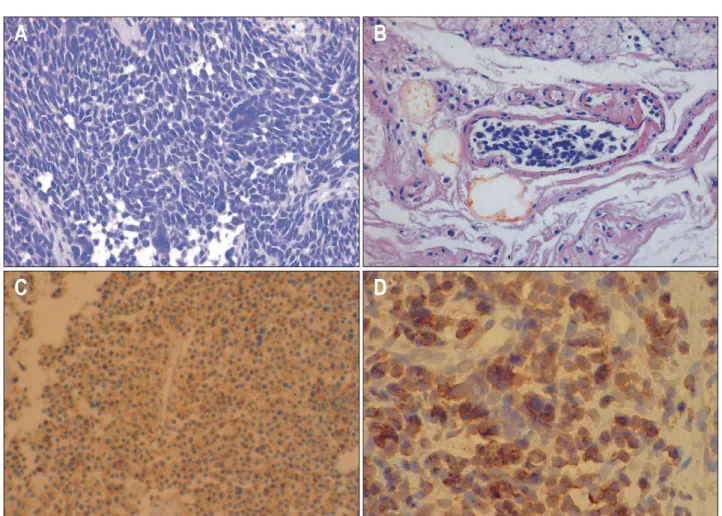Fig.  3.  Endoscopic  retrograde  cho- cho-langiographic  findings.  (A)   Com-plete  luminal  obstruction  is  seen  at  the  level  of  the  proximal   com-mon  bile  duct