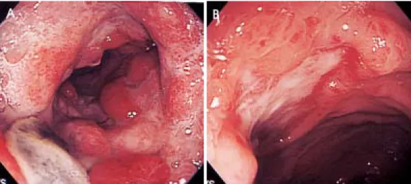 Fig. 1. Initial  colonoscopic  findings.  Multiple  geographic  ulcerations  are  showed  at  distal  transverse  colon  (A)  and  several  transverse  directional  oval  shaped  ulcerations  are  also  showed  at  ascending  colon  (B).