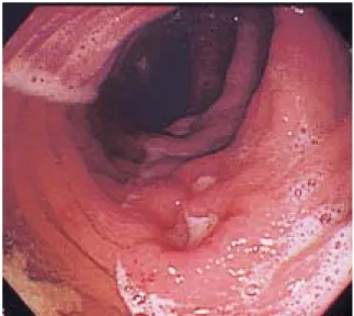 Fig.  4.  Colonoscopic  findings  after  2  months  of  anti-tuberculous  therapy.  Previous  ulcerative  lesions  are  changed  to  whitish  scars  implicating  reasonable  response