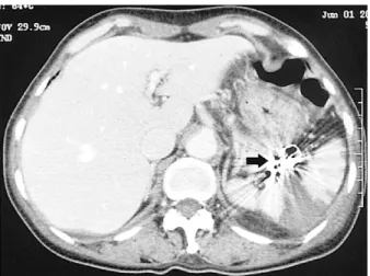 Fig. 3. Abdominal CT finding. Abdominal CT after interventional therapy shows multiple coils in the splenic hilum (arrow) and partial infarction of spleen.