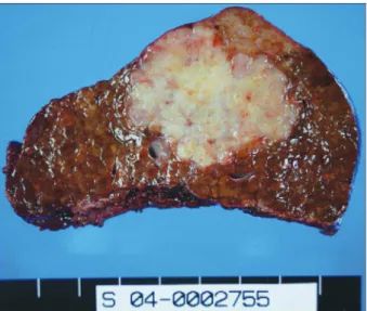 Fig. 4. Microscopic finding of the resected tumor. Both trabecular- trabecular-sinusodial growth pattern and glandular formation are seen (H&amp;E stain, ×400).