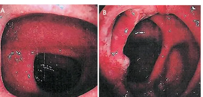 Fig. 1. 1. 1. 1. Initial colonoscopic finding. (A) Wide spread subepithelial hemorrhagic spots are noted throughout the entire colon