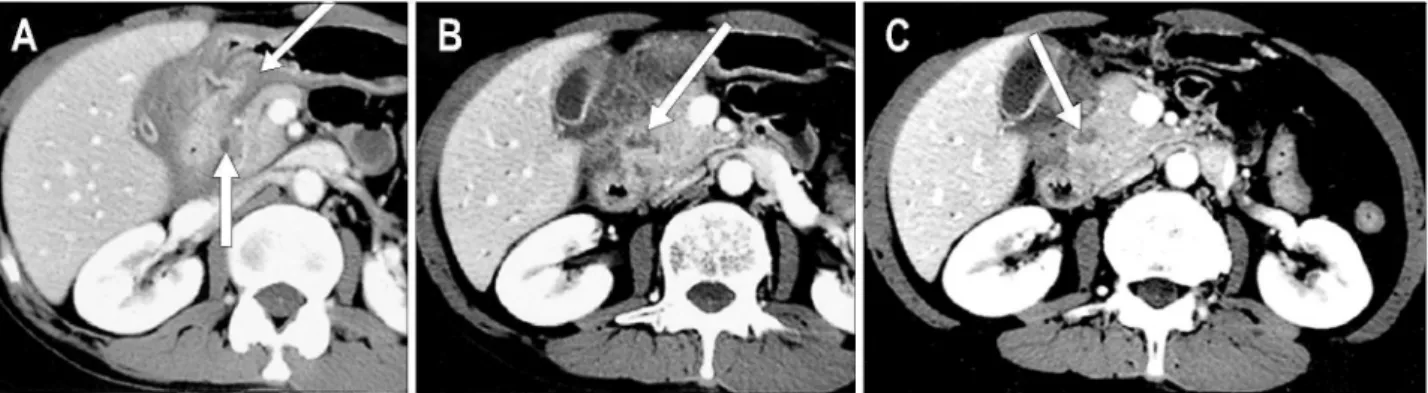 Fig. 2. Barium contrast duodenography. It shows segmental stenosis and fold thickening of the proximal second portion of duodenum.