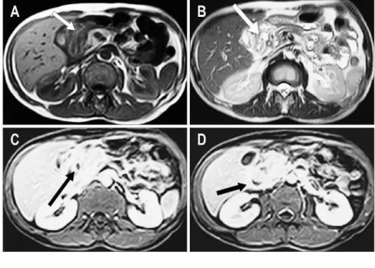 Fig. 4. Cross section through the duodenum. The duodenal wall is thickened with Brunner's gland hyperplasia (thin arrow)
