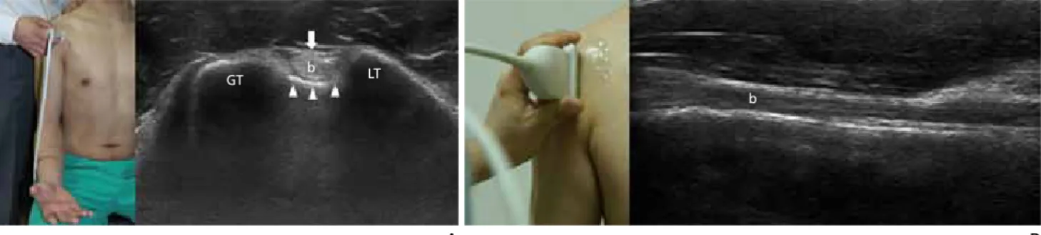 Figure 2.  Examination position and ultrasonography findings of subscapularis tendon. (A) Long axis scan shows subscapularis tendon (S), lesser tuberosity (LT), bicipital  groove (thick arrow), and coracoid process (arrow head)