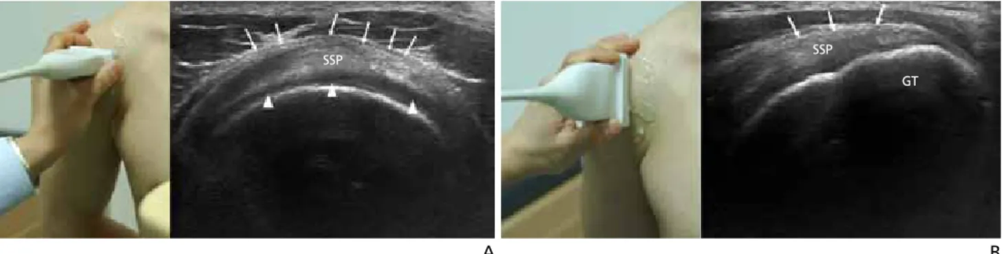 Figure 4.  Examination position and ultrasonography findings of infraspinatus  tendon
