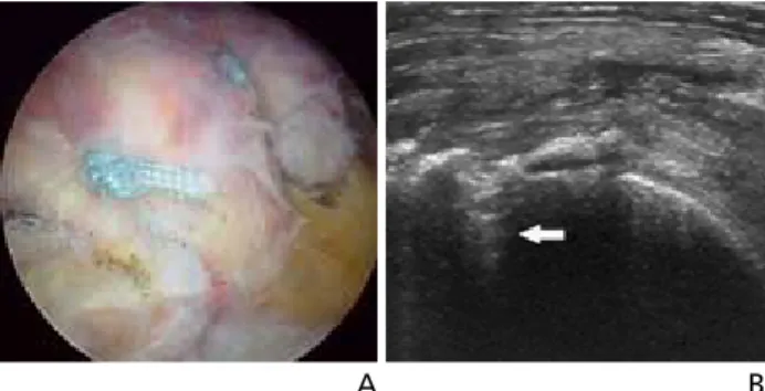 Figure 8.  Ultrasonography findings of calcific tendinitis of shoulder. (A) The  ultrasonography finding of type I calcific tendinitis shows hyperechoic focus  with well-defined posterior acoustic shadowing and (B) type III calcific  tend-initis shows amor