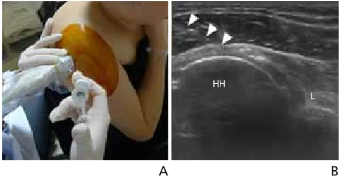 Figure 10.  Technique (A) and image (B) of ultrasonography guided subacro- subacro-mial bursal injection