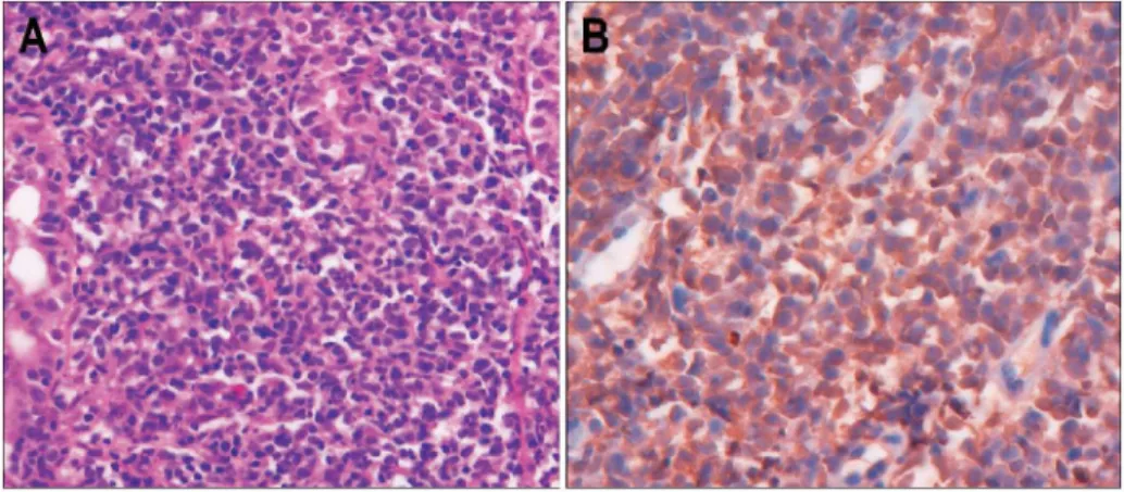 Fig. 1. Endoscopic finding. It shows a huge ulcerative lesion on the greater curvature side of lower body.