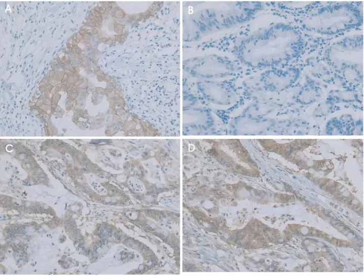 Fig. 1. Immunohistochemical staining of HER-2/neu overexpression (×200). (A) Strong complete membrane staining is observed in breast cancer cells (3＋, positive control)