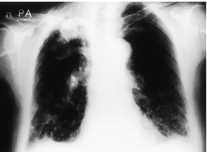 Fig. 1. Chest X-ray. It shows nodulo-streaky infiltration with inflammatory granuloma in both lung parenchyma.