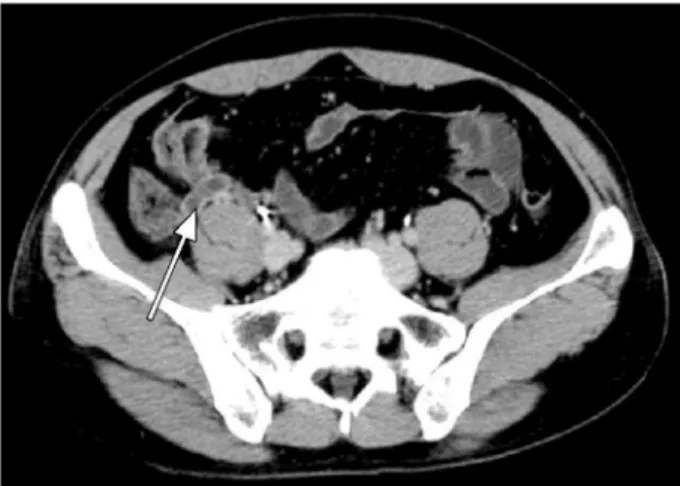Fig. 2. CT scan shows a filling defect (thrombus) in superior me- me-senteric vein.