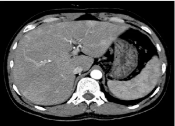 Fig. 4. CT scan after a month. Thrombus in superior mesenteric vein is resolved.