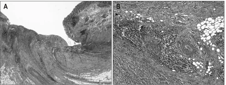 Fig.  4.  Gross  finding.  The  specimen  is  a  product  of  ileocecetomy,  including  cecum  attached  to  ileum  and  appendix