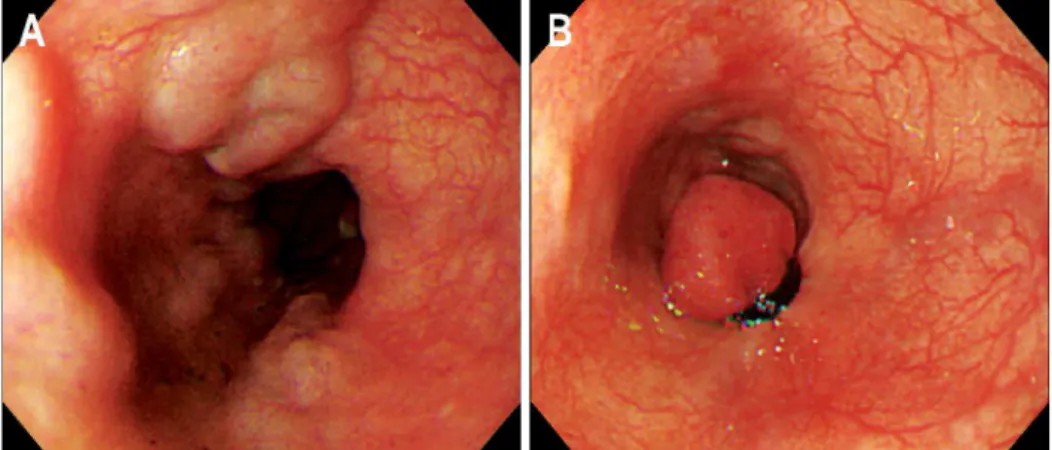 Fig. 3. Emergent endoscopic finding of the distal second portion of duodenum. It shows a blood-oozing erosion on the surface of large nodular duodenal varices.