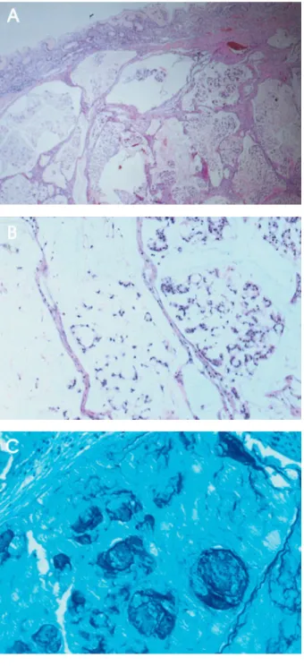 Fig. 3. Microscopic finding. (A) The mass locates submucosal and proper muscular layer, which is characterized by prominent glandular formations (H&amp;E stain, × 40)