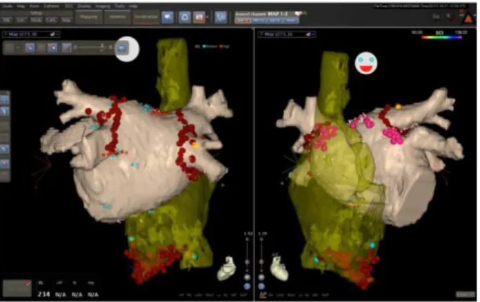 Figure 3.  Electroanatomical mapping using NavX system (St. Jude Medical, St. 