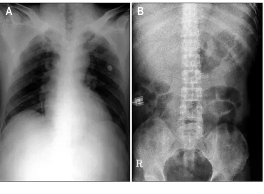 Fig.  1.  Simple  X-ray.  (A)  There  is  no  free  air  below  the   dia-phragm  on  chest  X-ray