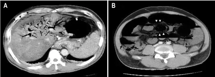 Fig.  3.  Abdominal  CT  finding.  (A)  Multifocal  branching-type  air  densities  are  noted  in  superior  mesenteric  vein  and  peripheral  portion  of  the  liver  (arrow)  with  air  and  fluid  collection  in  perihepatic  space  (arrowhead)