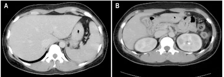 Fig.  3.  Abdominal  computed  tomography.  (A)  There  is  no  focal  lesion  in  liver