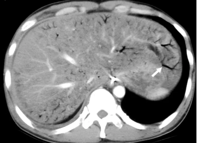 Fig.  2.  Abdominal  CT  scan  (case  1)  shows  diffuse  dilated  bowel  loops  with  air-fluid  levels  and  pneumatosis  intestinalis.