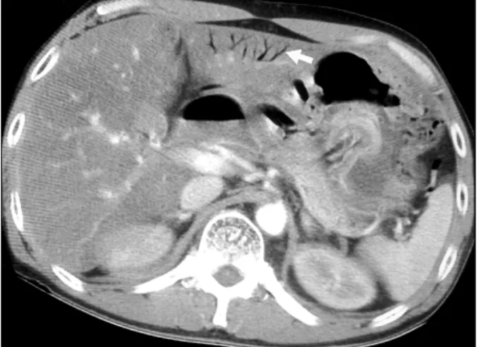 Fig.  5.  Abdominal  CT  (case  2)  shows  pancreatic  necrosis  (arrow),  peripancreatic  fluid  collections,  small  bowel  dilatations,  and  pneumatosis  intestinalis.