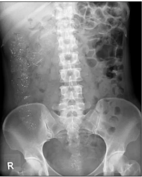 Fig.  1.  Abdominal  X-ray  finding.  Multiple  radio-opaque  foci  along  the  gastrointestinal  tract  and  gas  distension  are  noted  in  the  entire  colon.