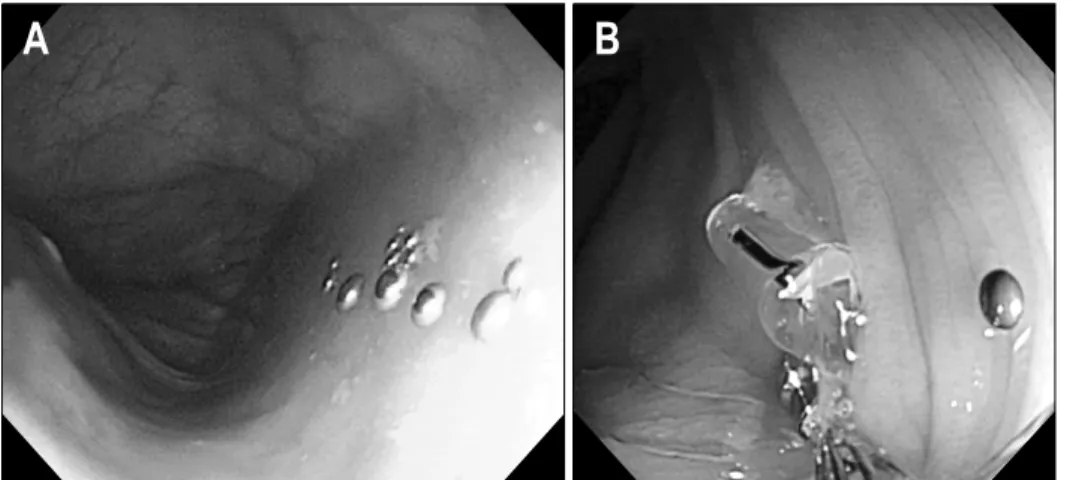 Fig.  3.  Colonoscopic  finding.  It  reveals  multiple  small  metallic  beads  suggesting  mercury  (A)  and  several  pieces  of  glass  (B)  in  the  hepatic  flexure.