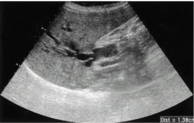 Fig. 1. Abdominal ultrasonographic finding. It shows diffuse dilatation of the intra and extrahepatic bile duct.