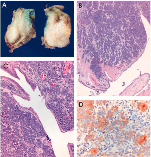 Fig. 4. Gross and microscopic finding of the mass. (A) The cut section shows an ill-defined pale tan to white, firm and solid tumor mass in the wall of common bile duct