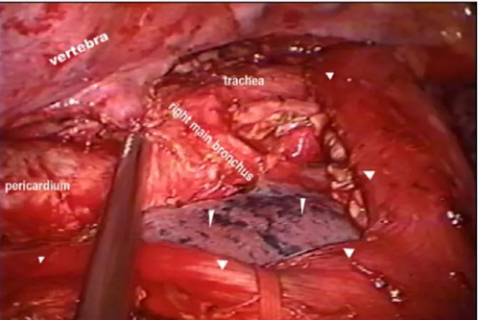 Fig.  1.  Typical  positioning  of  the  thoracoscopic  camera  and  in- in-struments  for  an  approach  to  esophagectomy  in  prone  position