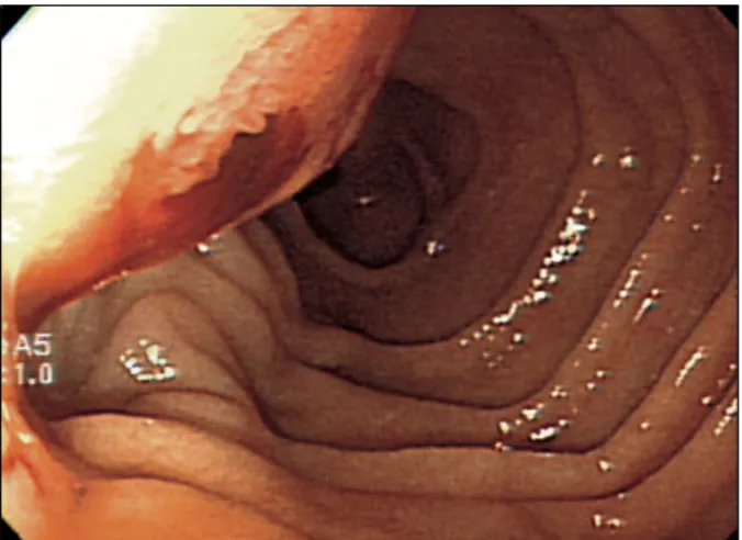 Fig.  1.  Duodenoscopic  finding.  Dark  bloody  liquid  ooze  out  of  the  ampulla  of  Vater.
