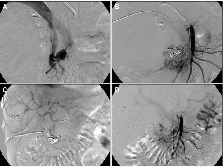 Fig.  4.  Embolization  of  draining  veins  through  portal  vein.  (A)  Draining  vein  of  the  pancreatic  AVMs  is  selected  with  angiographic  catheter  (5F)  through  the  portal  vein