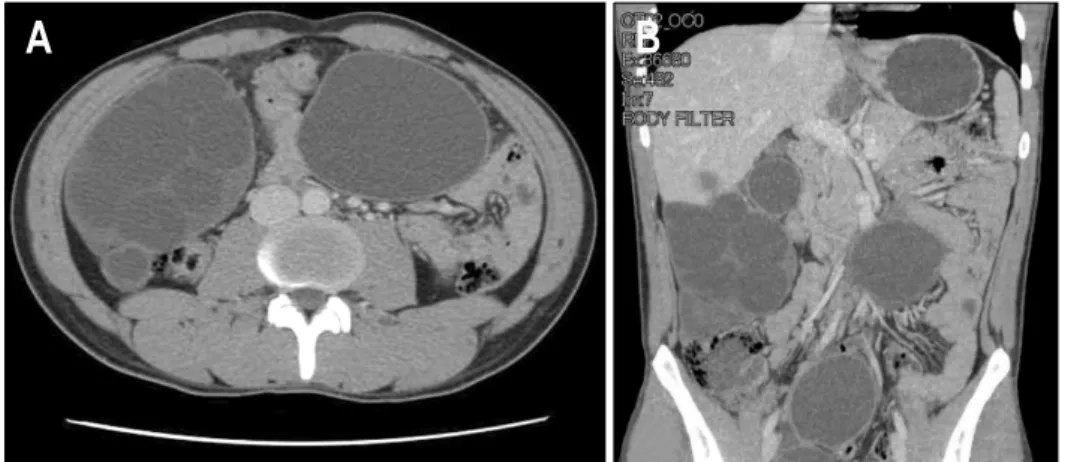 Fig.  2.  CT  scan  of  the  abdo- abdo-men.  It  shows  multiple  septated  cystic  lesion  (A)  and  multiple  variable  sized  cystic  lesions  in  liver  and  intraperitoneum  (B).