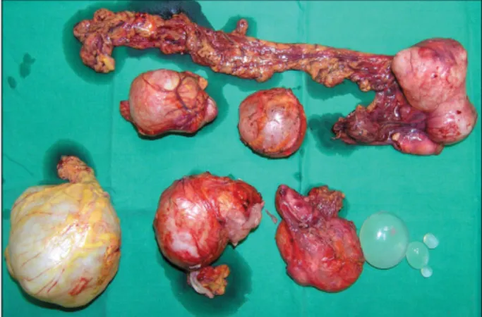Fig.  4.  Microscopic  finding  of  resected  cyst.  It  shows  outer  thick  laminated  membrane  (arrow  head)  and  inner  thin  germinal  layer  (arrow)  (H&amp;E  stain,  ×100).