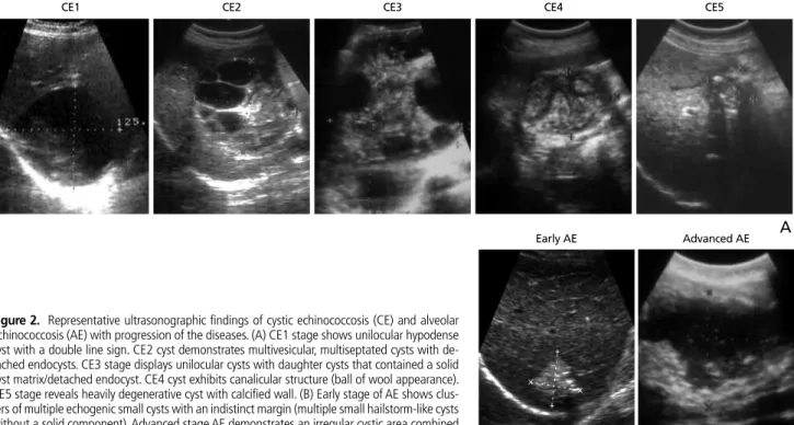 Figure 2.  Representative ultrasonographic findings of cystic echinococcosis (CE) and alveolar  echinococcosis (AE) with progression of the diseases