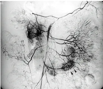 Fig. 1. Superior mesenteric angiogram. It shows a hypervascular- hypervascular-staining lesion (arrowheads) in the distal duodenum and the proximal jejunum.