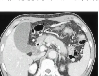 Fig. 1. Abdominal CT findings. The pancreas is diffusely swollen without any calcification or stones.