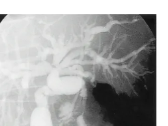 Fig. 4. Percutaneous transhepatic cholangiogram. It reveals multiple strictures of the hepatic hilum and narrowing of the intrapancreatic portion of the common bile duct is also noted.