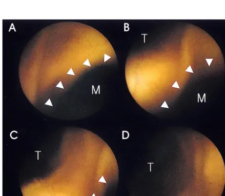 Fig. 1. The results of capsule endoscopy. The video sequences (A, B, C, D) show that the capsule moved from Meckel's diverticulum (M) forwards into a different lumen, which identified as the distal ileum (T)